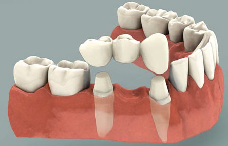 Dental Bridge Illustration Dental Bridge Illustration
