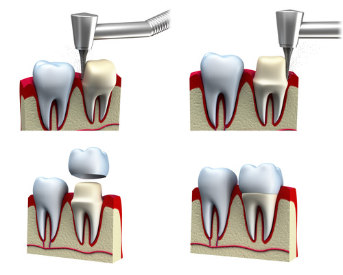 Dental Crown Install