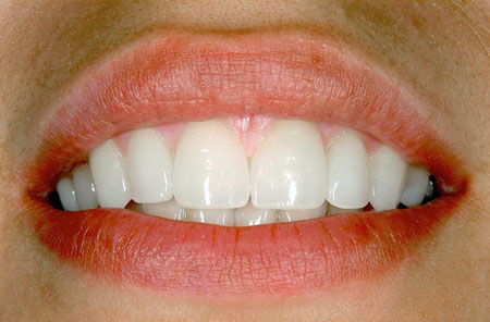 Dental Veneers From a Specialist in Bellevue