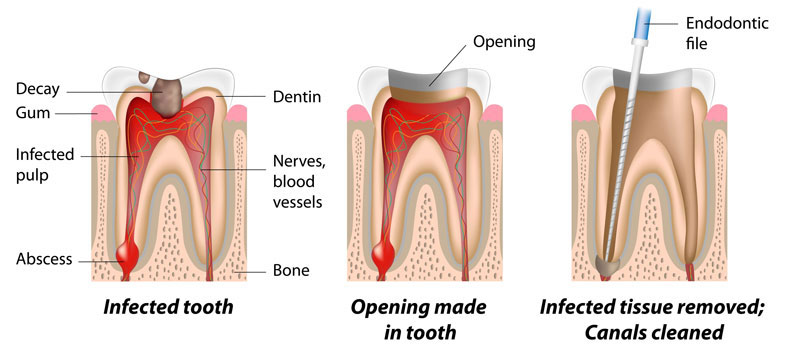 Root Canal Procedure