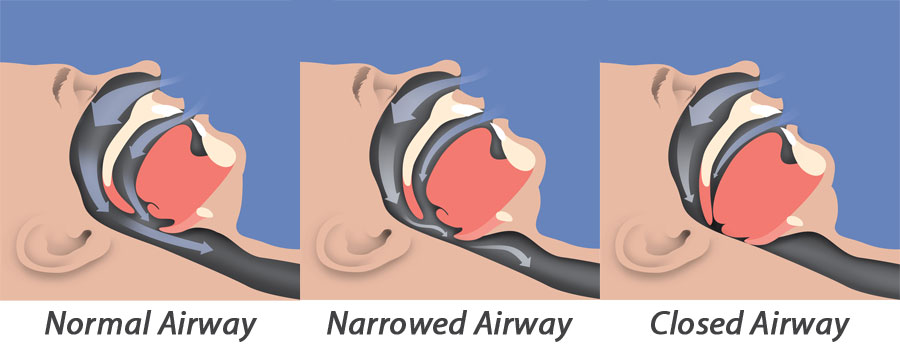 Sleep Apnea Airway Illustration