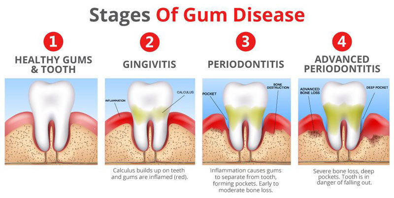 Periodontal Disease Stages