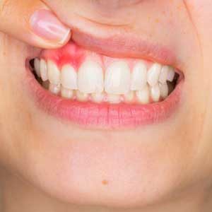 pointing to inflamed gums upper teeth